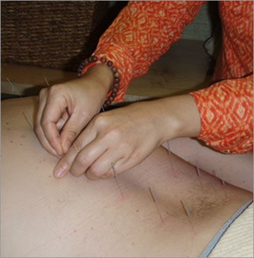 acupuncture