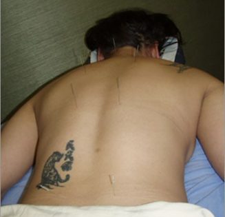 lower back pain acupuncture