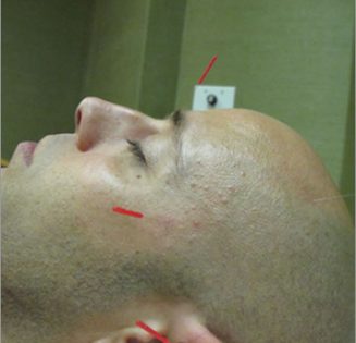 facial acupuncture
